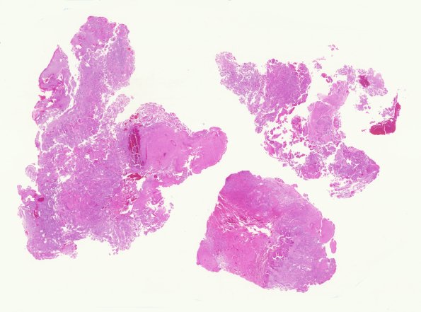 4A1 Papillary Glioneuronal Tumor (PGNT, Case 4) 1 H&E whole mount