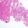 4A2 Papillary Glioneuronal Tumor (PGNT, Case 4) Area A H&E 4X