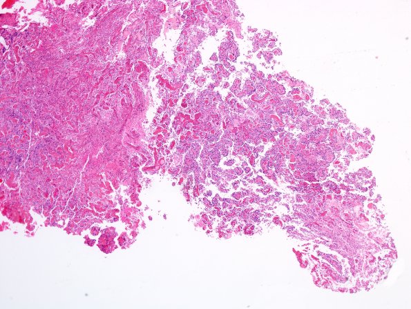 4A2 Papillary Glioneuronal Tumor (PGNT, Case 4) Area A H&E 4X