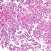 4A3 Papillary Glioneuronal Tumor (PGNT, Case 4) Area A H&E 10X