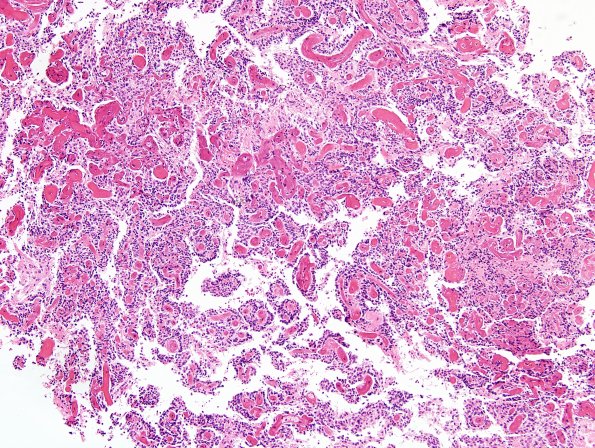 4A3 Papillary Glioneuronal Tumor (PGNT, Case 4) Area A H&E 10X