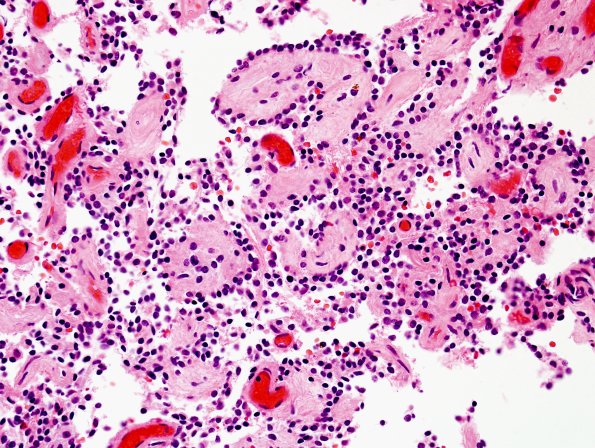 4A4 Papillary Glioneuronal Tumor (PGNT, Case 4) H&E 13.jpg