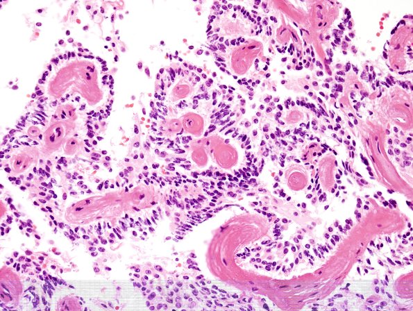 4A5 Papillary Glioneuronal Tumor (PGNT, Case 4) H&E 8.jpg