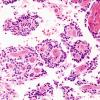 4A6 Papillary Glioneuronal Tumor (PGNT, Case 4) H&E 5.jpg