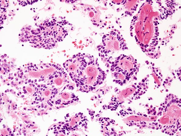 4A6 Papillary Glioneuronal Tumor (PGNT, Case 4) H&E 5.jpg