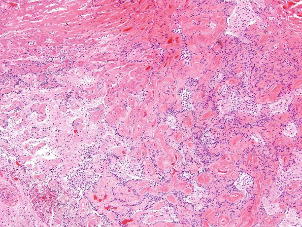 4A7 Papillary Glioneuronal Tumor (PGNT, Case 4) H&E 9.jpg