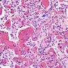 4A8 Papillary Glioneuronal Tumor (PGNT, Case 4) Area A H&E 40X 1