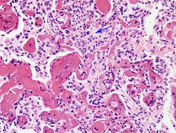 4A8 Papillary Glioneuronal Tumor (PGNT, Case 4) Area A H&E 40X 1