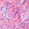 4A9 Papillary Glioneuronal Tumor (PGNT, Case 4) H&E 11 copy.jpg