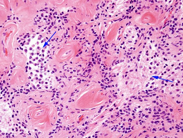 4A9 Papillary Glioneuronal Tumor (PGNT, Case 4) H&E 11 copy.jpg