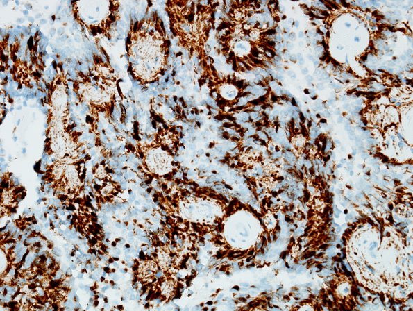 4B5 Papillary Glioneuronal Tumor (PGNT, Case 4) Area A GFAP 40X 1