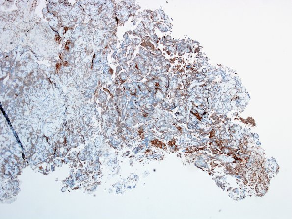 4C2 Papillary Glioneuronal Tumor (PGNT, Case 4) Area A SYN 4X