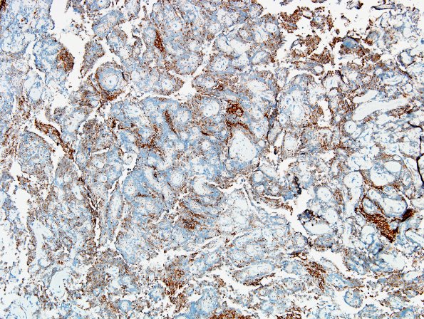 4C3 Papillary Glioneuronal Tumor (PGNT, Case 4) Area A SYN 10X