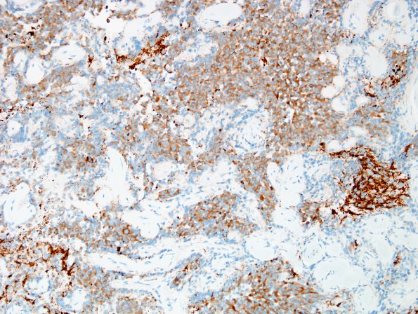 4C3 Papillary Glioneuronal Tumor (PGNT, Case 4) Area A SYN 20X 2