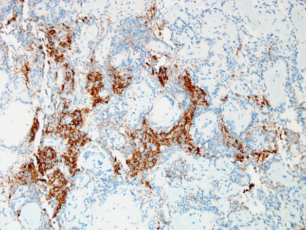 4C4 P4apillary Glioneuronal Tumor (PGNT, Case 4) Area A SYN 20X 1