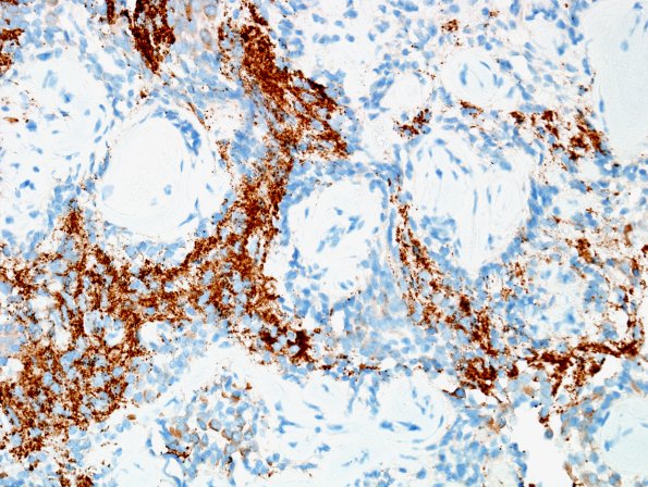 4C5 Papillary Glioneuronal Tumor (PGNT, Case 4) Area A SYN 40X 2