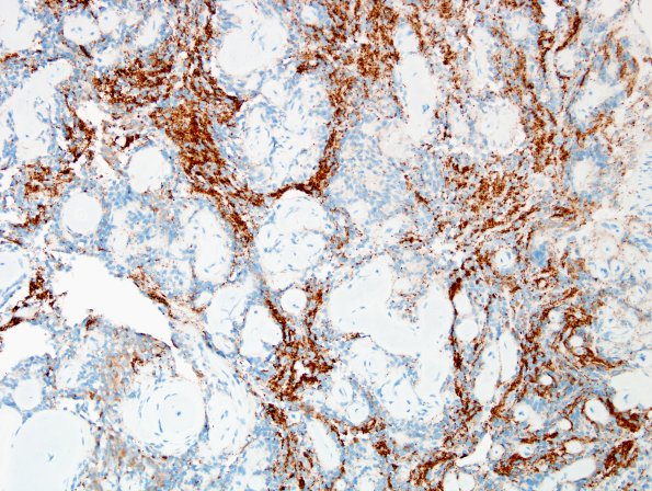 4C6 Papillary Glioneuronal Tumor (PGNT, Case 4) Area A SYN 40X 1