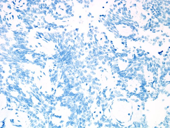 4E2 Papillary Glioneuronal Tumor (PGNT, Case 4) Area A NeuN 40X