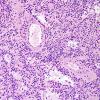 5A1 Papillary Glioneuronal Tumor (PGNT, Case 5) H&E 1.jpg