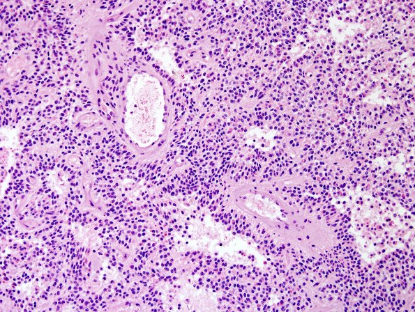 5A1 Papillary Glioneuronal Tumor (PGNT, Case 5) H&E 1.jpg