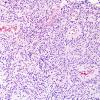 5A3 Papillary Glioneuronal Tumor (PGNT, Case 5) H&E 4.jpg