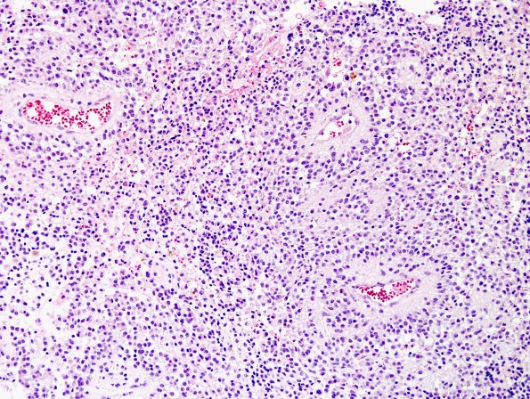 5A3 Papillary Glioneuronal Tumor (PGNT, Case 5) H&E 4.jpg