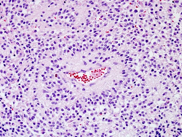 5A4 Papillary Glioneuronal Tumor (PGNT, Case 5) H&E 5.jpg