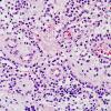 5A6 Papillary Glioneuronal Tumor (PGNT, Case 5) H&E 8.jpg