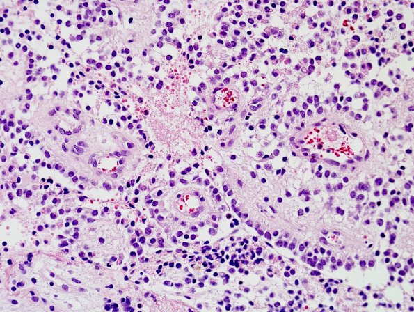 5A6 Papillary Glioneuronal Tumor (PGNT, Case 5) H&E 8.jpg