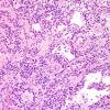 5A7 Papillary Glioneuronal Tumor (PGNT, Case 5) H&E 11.jpg