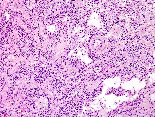 5A7 Papillary Glioneuronal Tumor (PGNT, Case 5) H&E 11.jpg