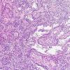 5A8 Papillary Glioneuronal Tumor (PGNT, Case 5) H&E 14.jpg