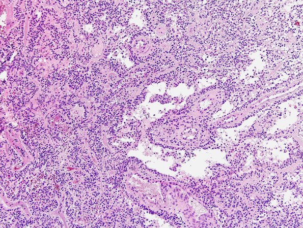 5A8 Papillary Glioneuronal Tumor (PGNT, Case 5) H&E 14.jpg