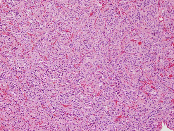 10A1 Paraganglioma (Case 10) H&E 1.jpg