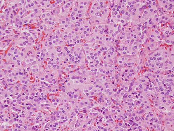 10A2 Paraganglioma (Case 10) H&E 2.jpg