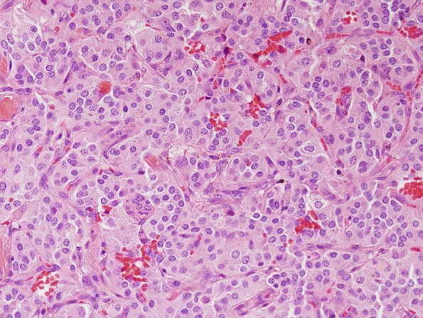 10A3 Paraganglioma (Case 10) H&E 4.jpg