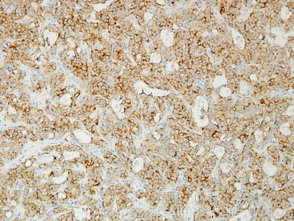 10B1 Paraganglioma (Case 10) SYN 2.jpg