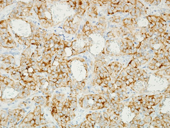 10B2 Paraganglioma (Case 10) SYN 1.jpg