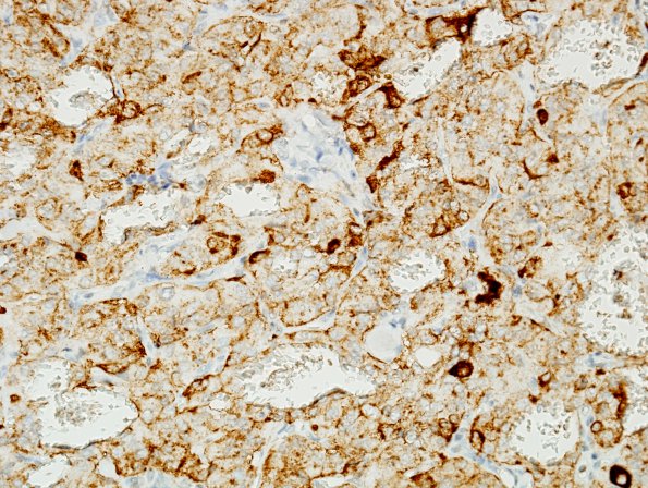 10C Paraganglioma (Case 10) Chr.jpg