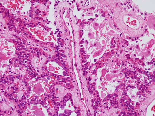 11A1 Paraganglioma GGL Diffn (AANP 2003 Case 2) H&E 1.jpg