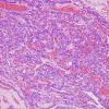 11A2 Paraganglioma GGL Diffn (AANP 2003-Case 2) H&E 5