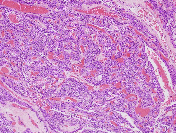 11A2 Paraganglioma GGL Diffn (AANP 2003-Case 2) H&E 5