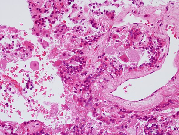 11A3 Paraganglioma GGL Diffn (AANP 2003 Case 2) H&E 3.jpg