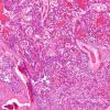 11A4 Paraganglioma GGL Diffn (AANP2003 Case 2) H&E 8.jpg