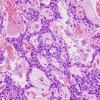 11A5 Paraganglioma GGL Diffn (AANP 2003-Case 2) H&E 3