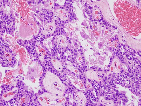 11A5 Paraganglioma GGL Diffn (AANP 2003-Case 2) H&E 3