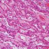 11A6 Paraganglioma GGL Diffn (AANP 2003 Case 2) H&E 9.jpg