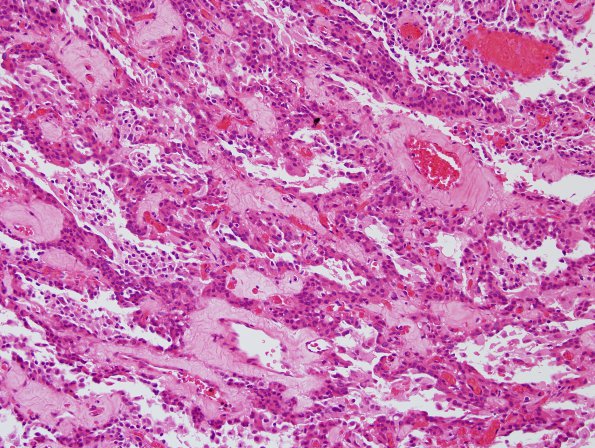 11A6 Paraganglioma GGL Diffn (AANP 2003 Case 2) H&E 9.jpg