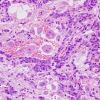 11A7 Paraganglioma GGL Diffn (AANP 2003-Case 2) H&E 4