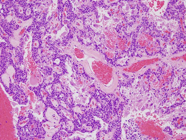 11A8 Paraganglioma GGL Diffn (AANP 2003-Slide 2) H&E 2